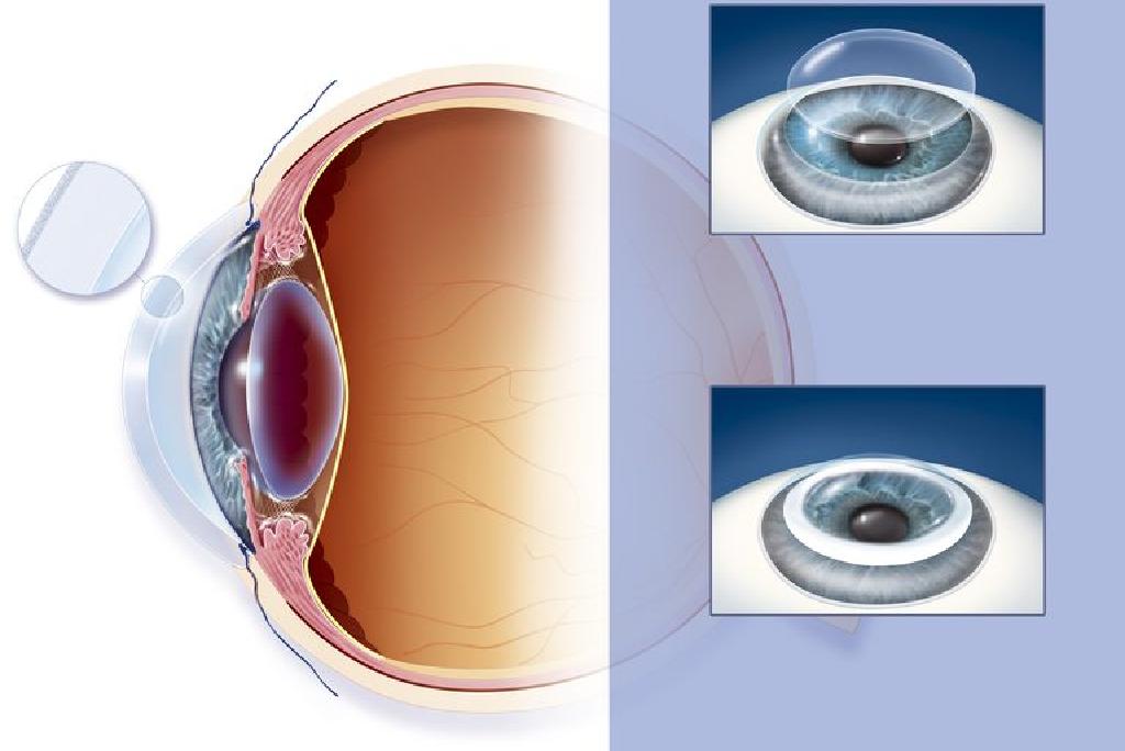 viziunea corneei mese oculare pentru restabilirea vederii