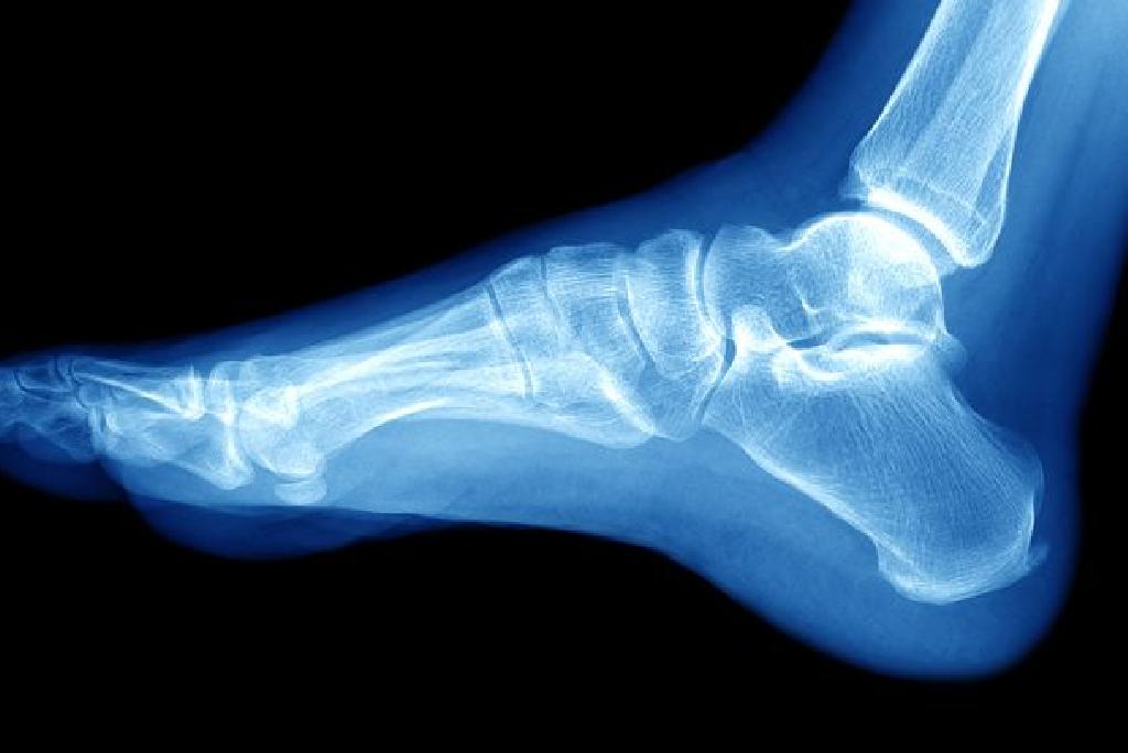Leziuni și fracturi ale articulației gleznei - Osteocondrita disecantă talară (OCDT)