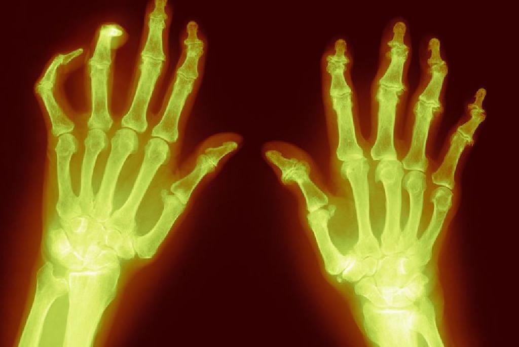 Bolni zglobovi prstiju na rukama – uzrok i liječenje
