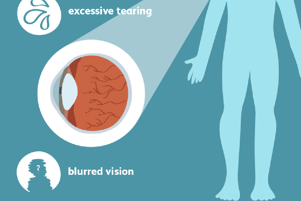 Fehér kisülés a szem sarkában: okok és kezelés - Sérülések 