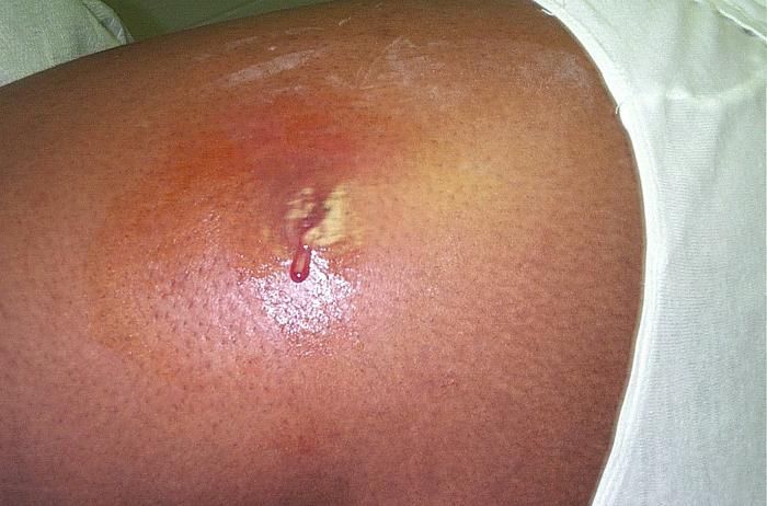 Një infeksion i lëkurës MRSA