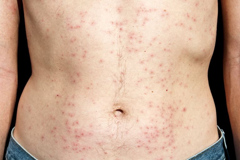 Folliculitis Hot Tub.