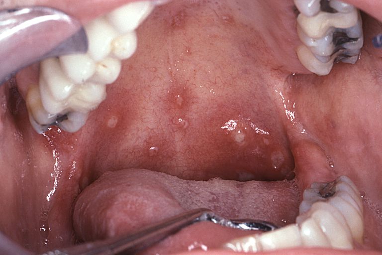 唇疱疹 溃疡疮和chancres之间的差异
