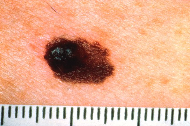 Nevi Displastici Atipici E Rischio Di Melanoma The Skin Cancer Foundation