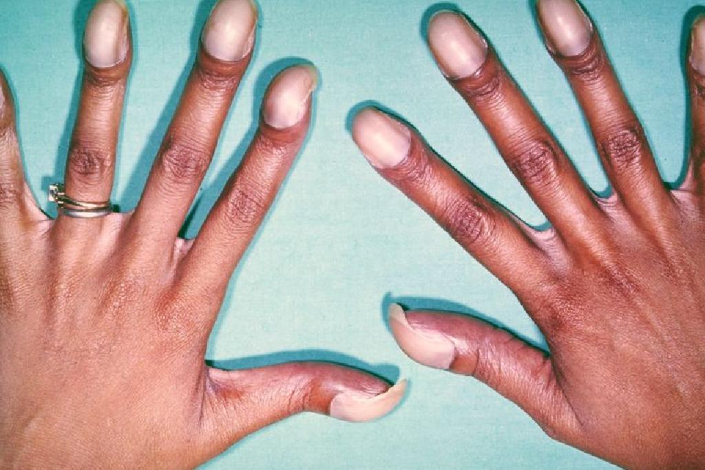 fungus az ujjak köröm kezében a körömgomba kezelésének javulása