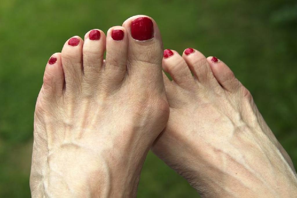 6 Tips untuk Menenangkan Sakit Bunion