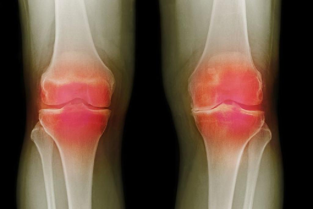Artroscopia de genunchi se recomanda atunci cand suferi de leziune de menisc sau de ligamente
