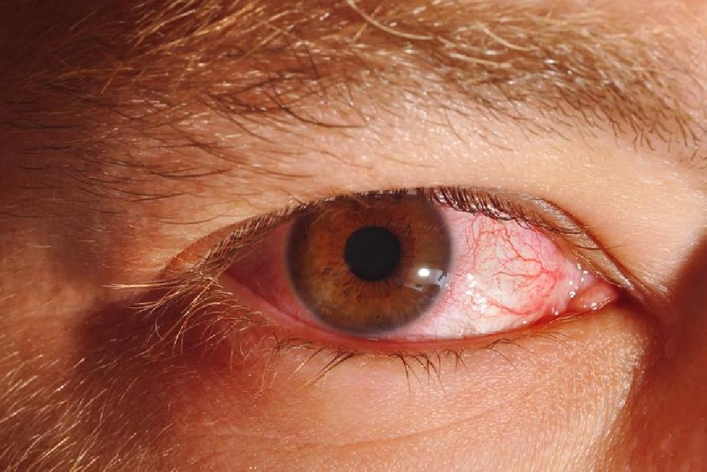 herpes oculare îmbunătățirea recuperării vederii