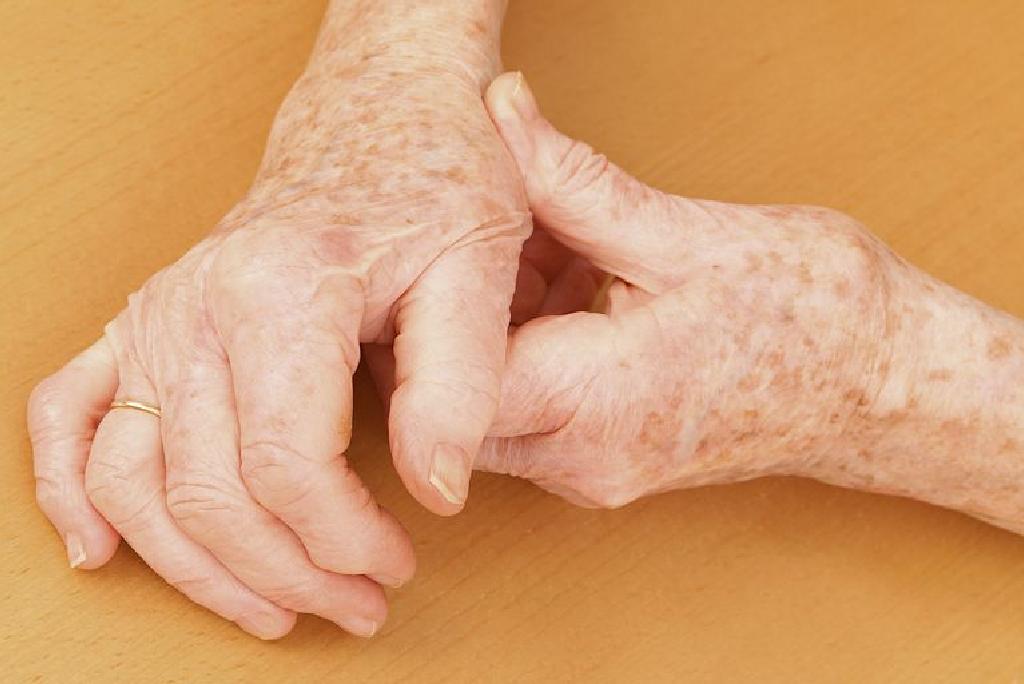 liječenje osteoartritisa ruku ozokeritom)