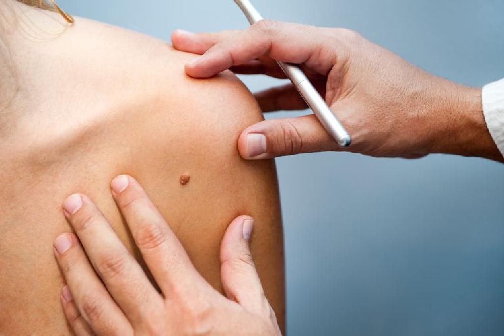 A korai stádiumú melanoma bőrrák kezelése