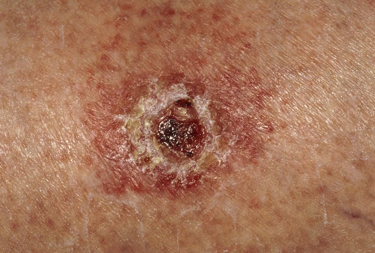 类型的皮肤癌的照片库