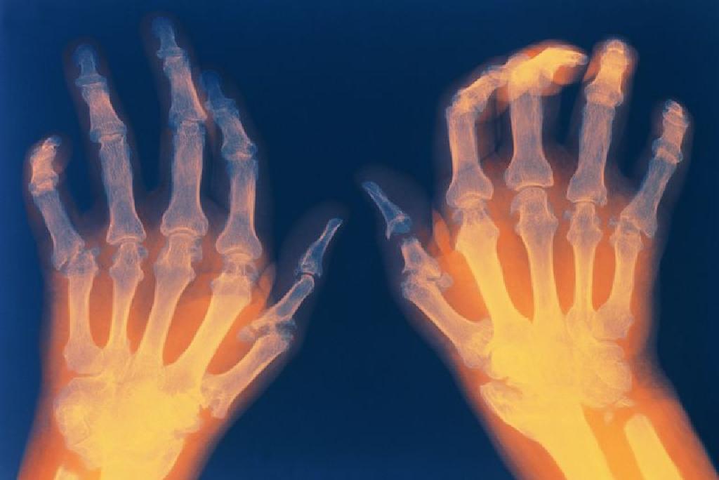 najbolje liječenje artritisa)