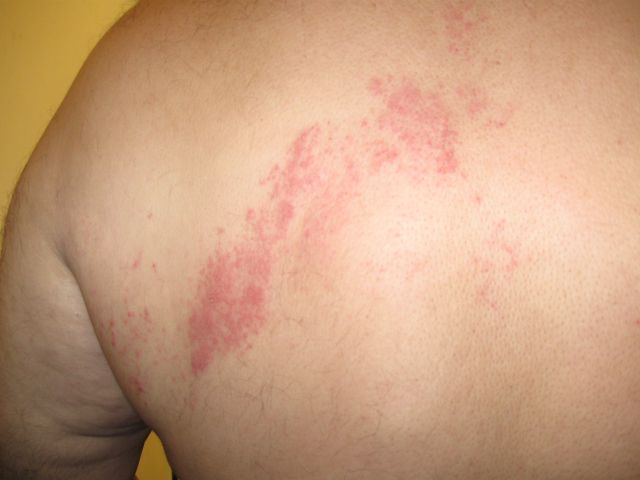 Herpes Zoster Simptomi Prichini Diagnoza I Lechenie