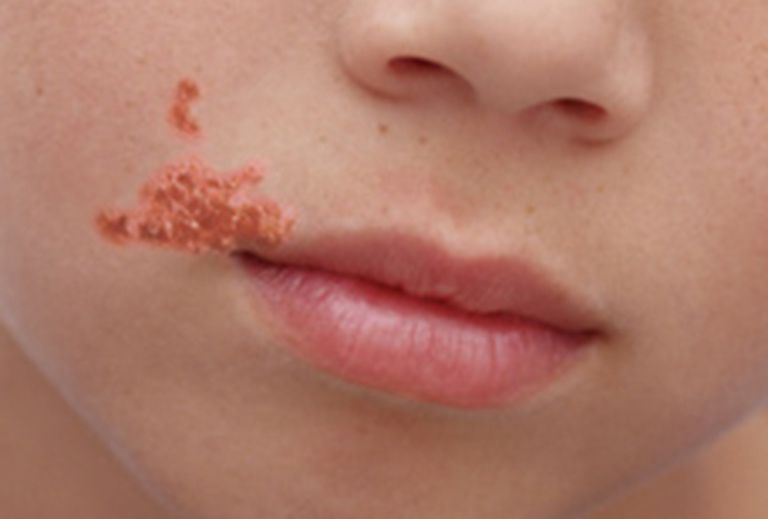 impetigo