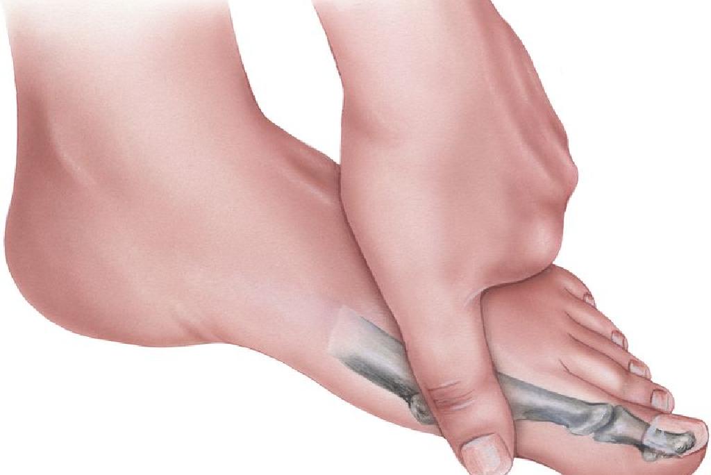 bolovi lijekovi za zglobove velikih nožnih prstiju