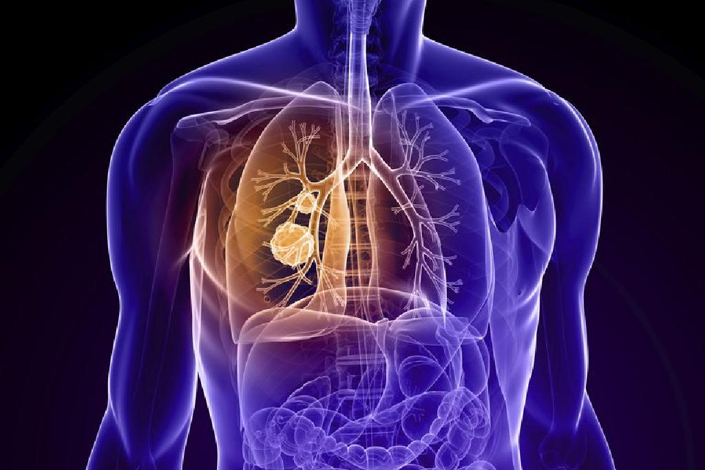 Rak pluća, ubica bez najave: Svi simptomi, sindromi i bolovi koje izaziva!