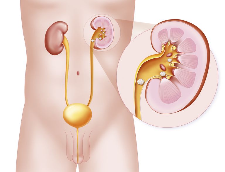 hátfájás alsó hátsó prosztatitis is prostatitis a urinary tract infection
