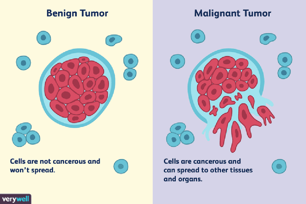 pierderea în greutate a tumorii celulelor celulelor