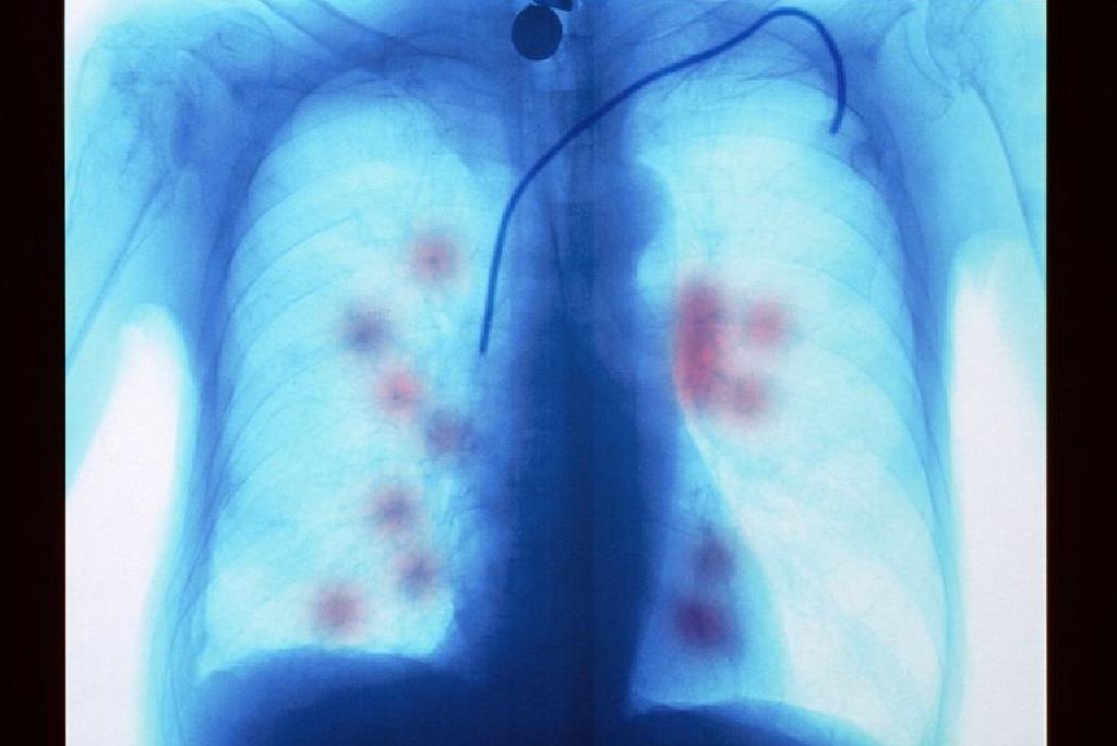 Fibroza pulmonară idiopatică - Medic Info