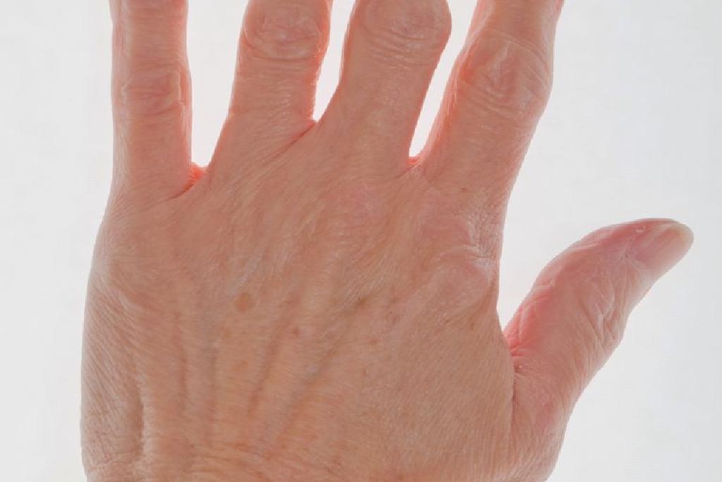 artrita în degetul mare