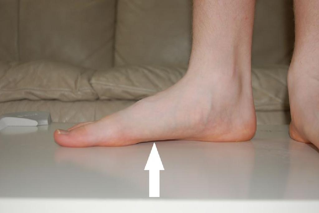 ravnih stopala i artritis liječenje)