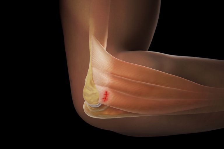 bol u laktu nakon modrica liječenje osteoartritisa prstiju s mastima