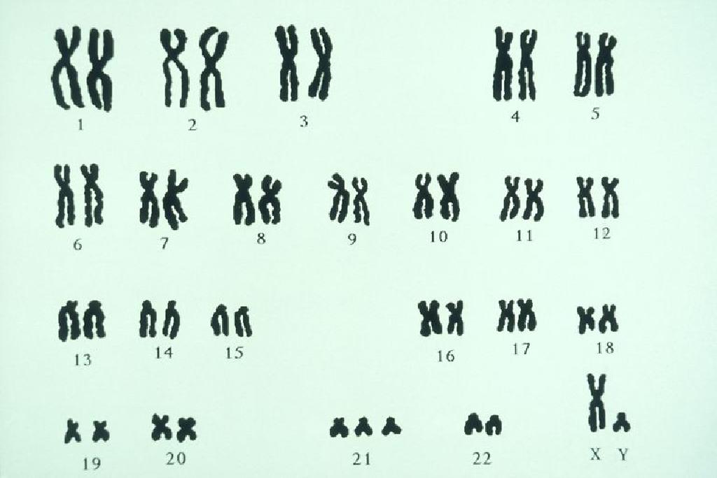 Translocation Trisomy Dan Mosaic Down Syndrome