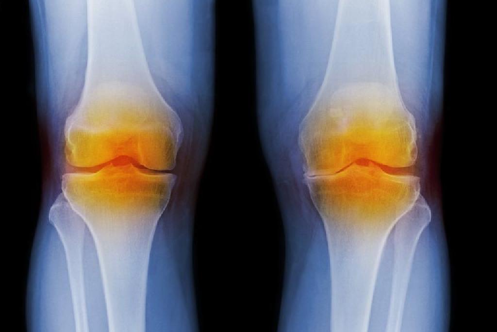 Kerosakan Bersama Dalam Rheumatoid Arthritis Dan Osteoartritis